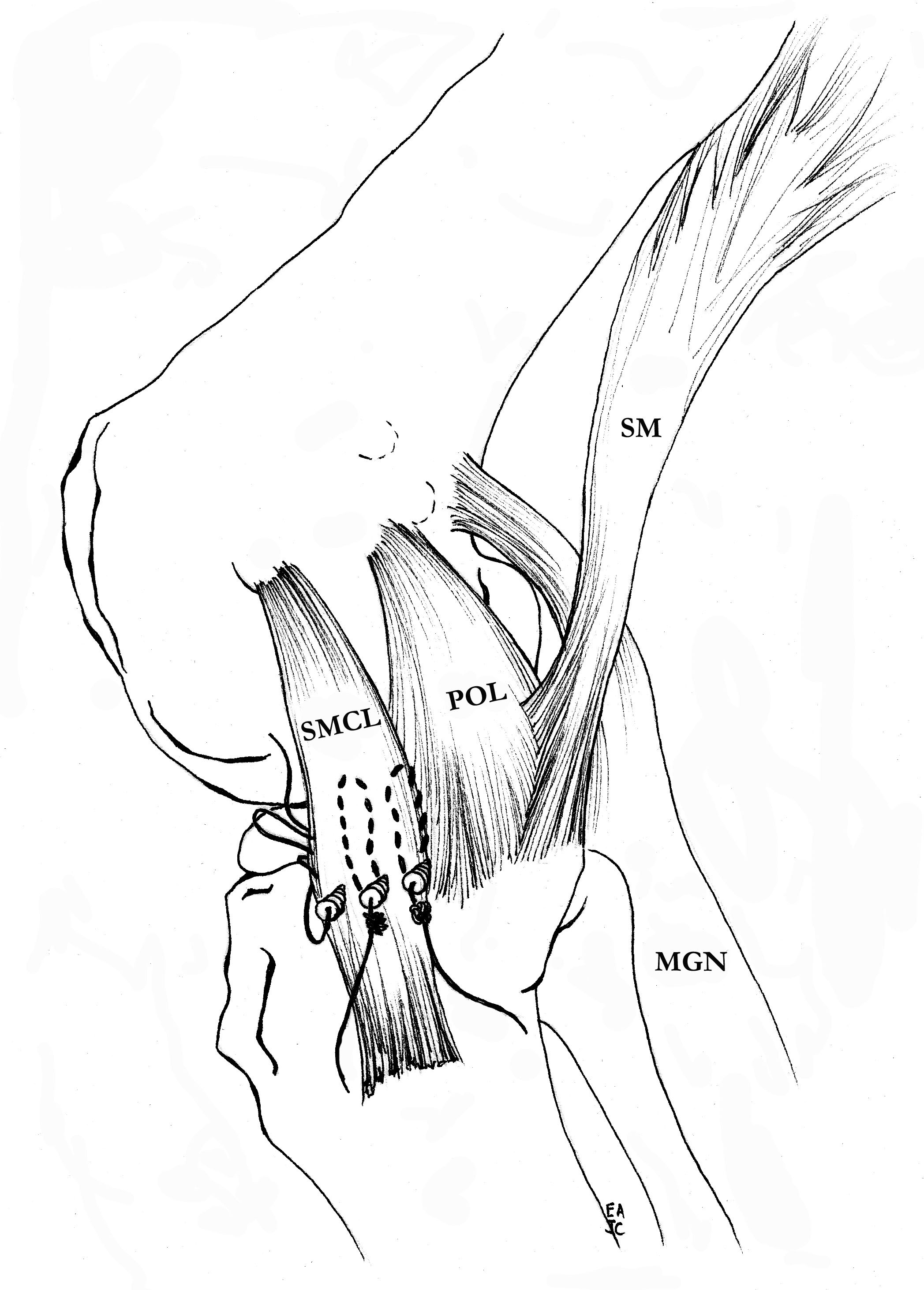 MCL tibial fixation 1